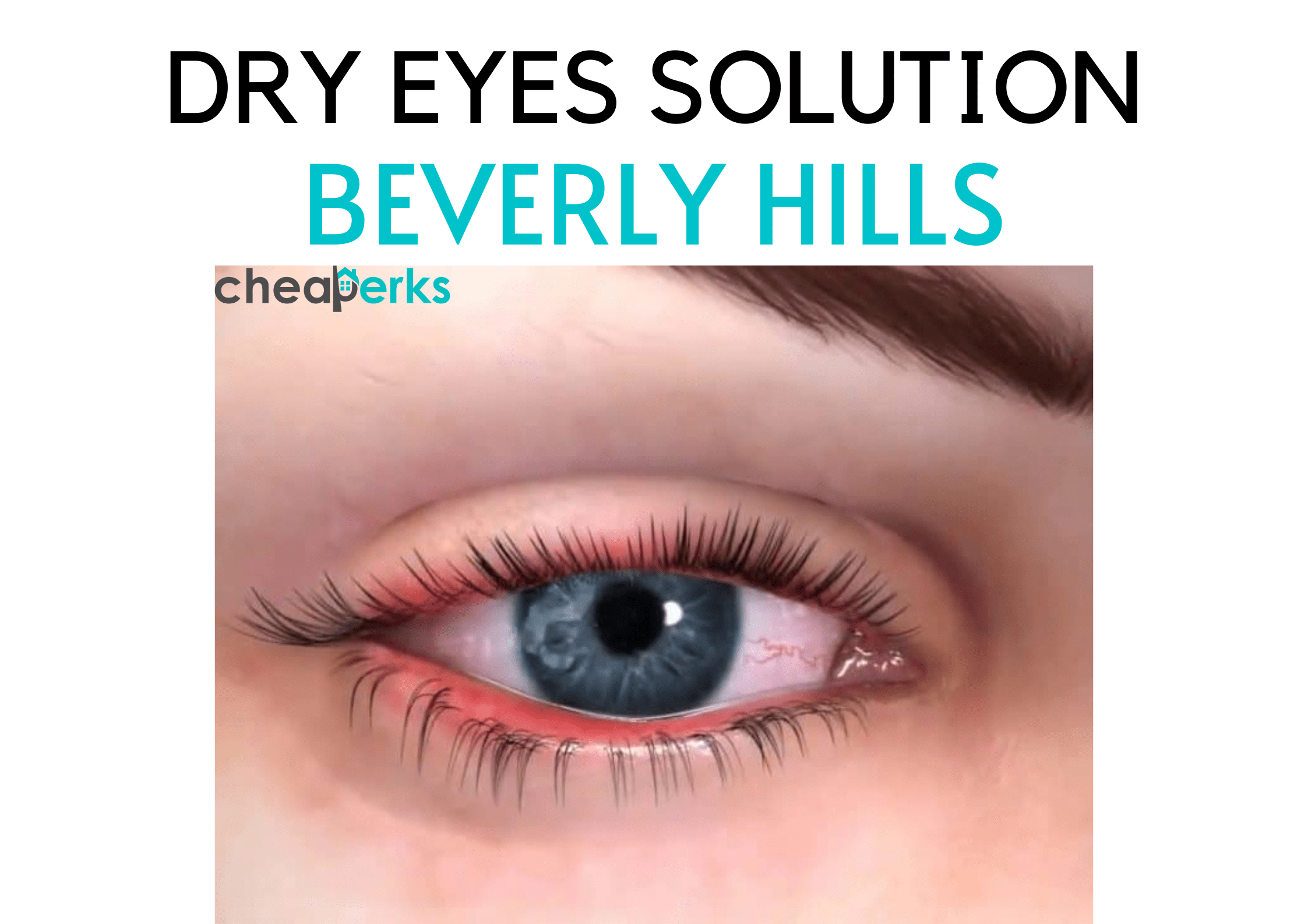 Dry Eyes Beverly Hills How to Prevent Dry Eyes? (GUIDE