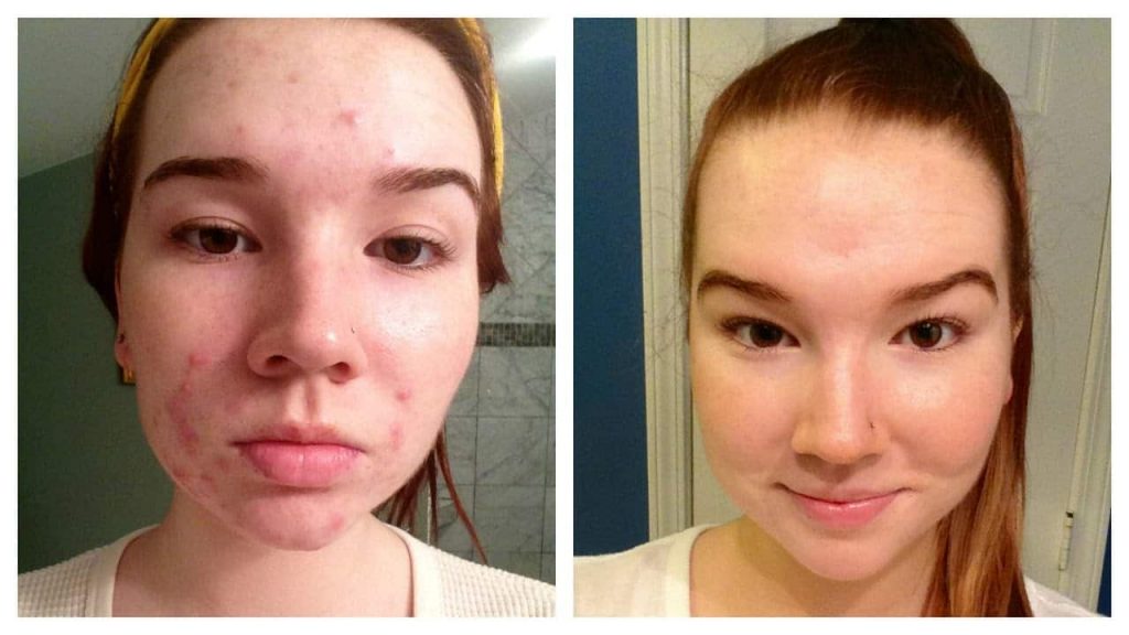 Acne Patches Before And After