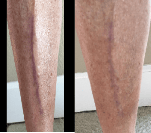 Scarzone Before & After