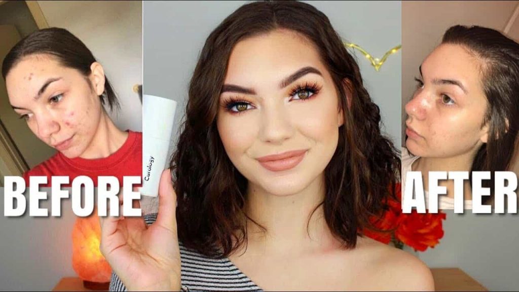 acne solution before & after