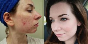 Curology Reviews Before After