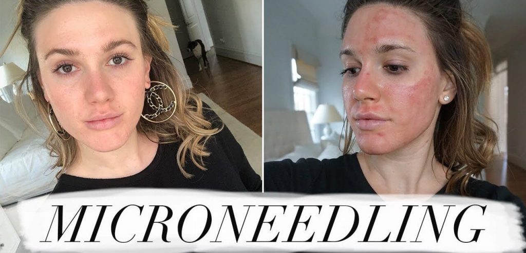 microneedling before after