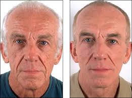 beverly hills dermal repair complex before and after