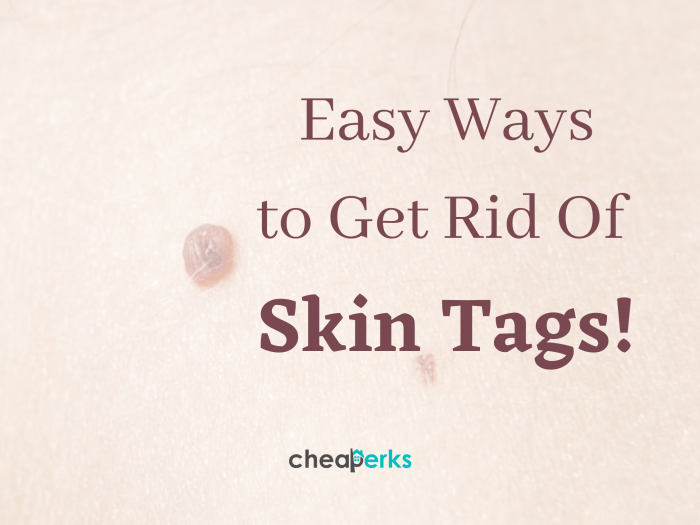 Easy Ways to Get Rid Of Skin Tags