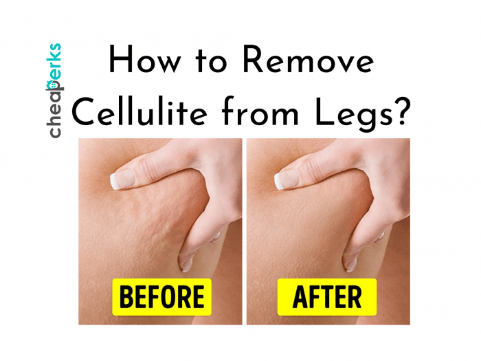 How to Remove Cellulite from Legs?