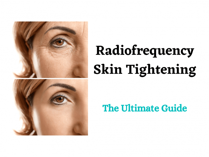 Radiofrequency Skin Tightening