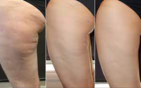 Ultrasonic Cellulite Remover Reviews
