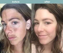 musely spot before after