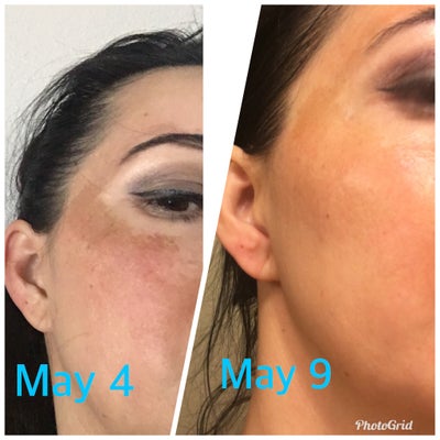 musely spot cream reviews