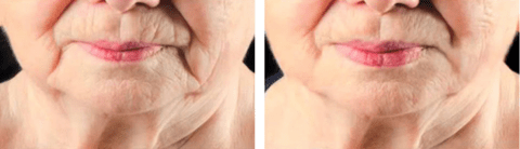 angelift before and after