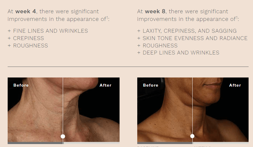 skinmedica neck correct cream before after