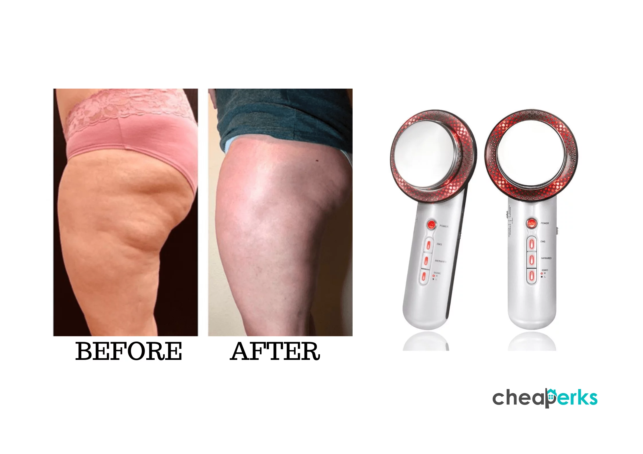 ultrasonic cellulite remover before and after